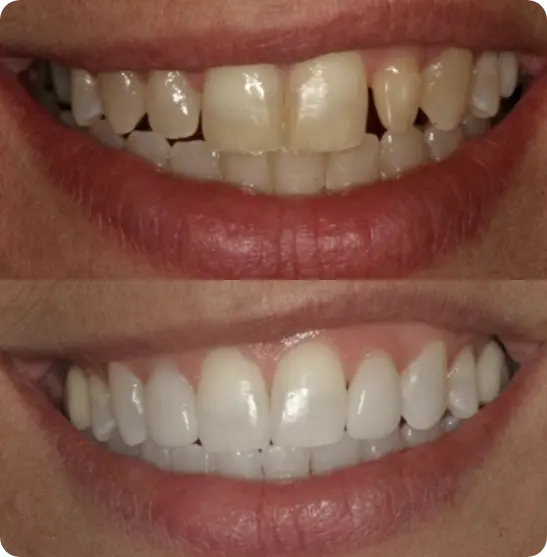 Before and after dental implants