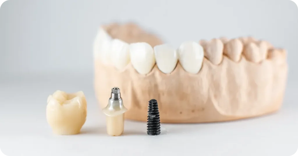 Dental Implants