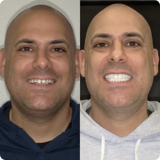 patient with veneers before and after
